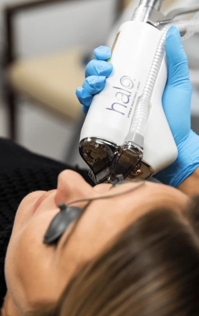 Halo Laser. Skin resurfacing. Laser Facial. BBL. Rosacea. Fine lines. wrinkles. sun damage. brown spots. Medical spa Greenwood Village. laser peel.